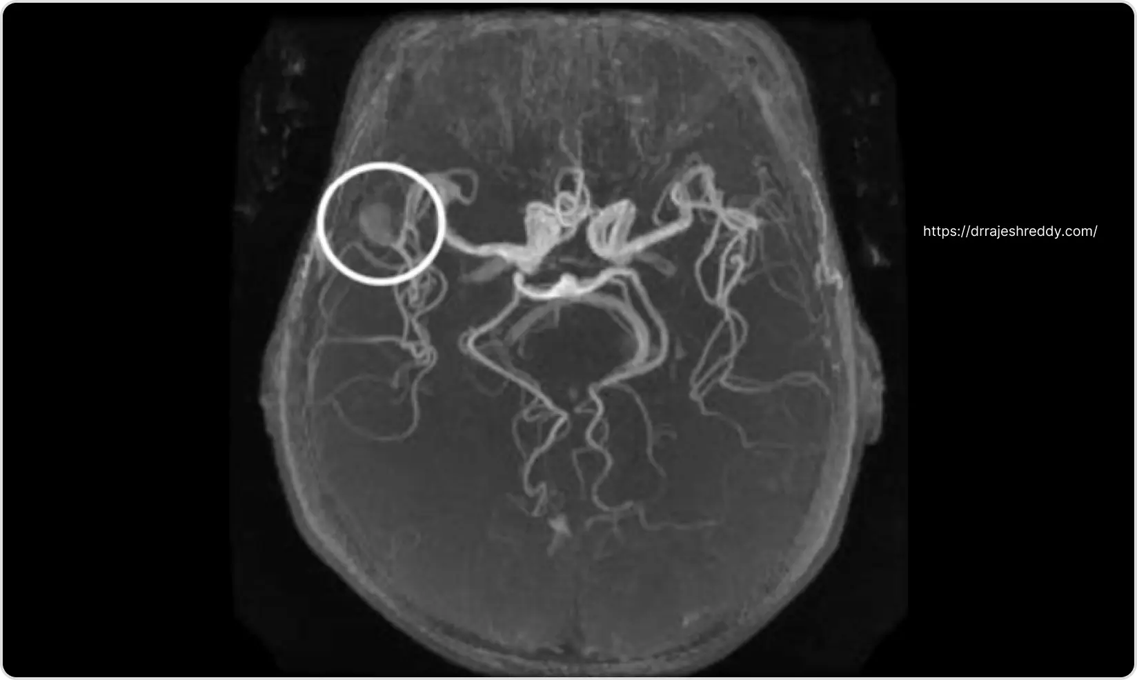 MR Angiogram Brain